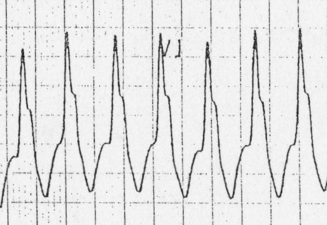 Vt Versus Svt Litfl Medical Blog Ecg Library Basics