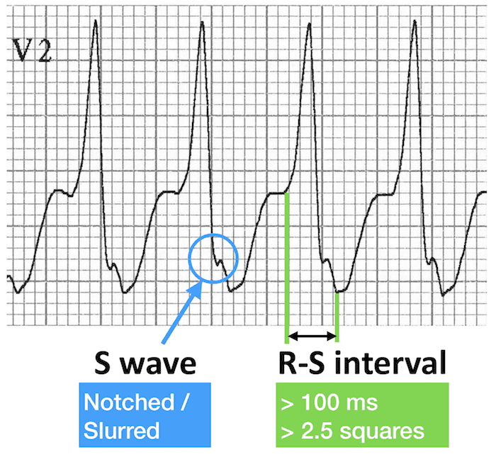 ECG VT V2 RS interval RBBB morphology 700