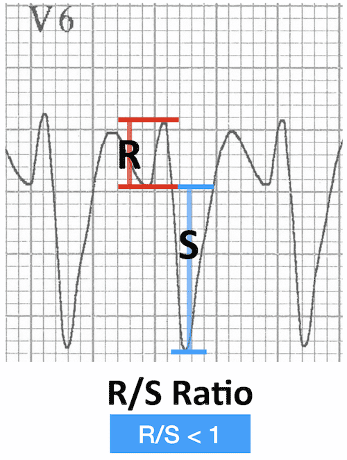 ECG VT V6 R-S ratio RBBB morphology 500