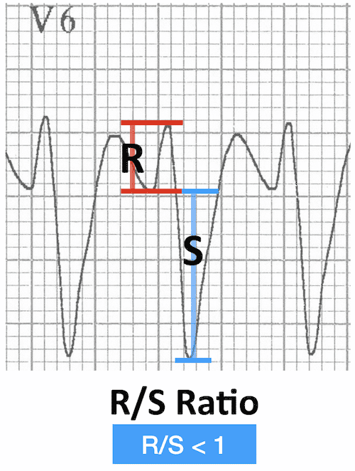 Vt Versus Svt Litfl Medical Blog Ecg Library Basics