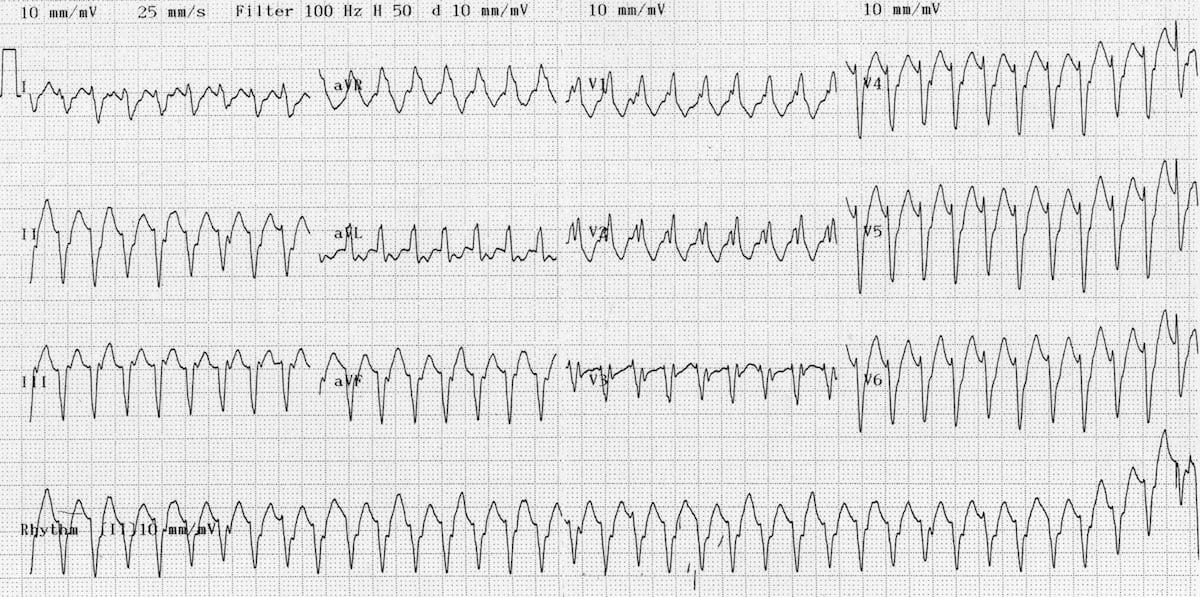 ventricular tachycardia vs supraventricular tachycardia