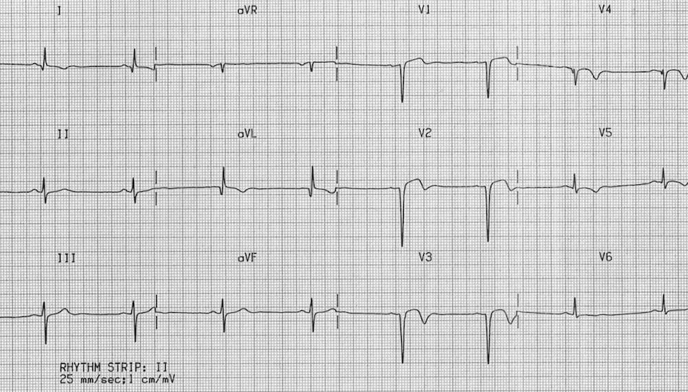 anterior myocardial infarction ecg