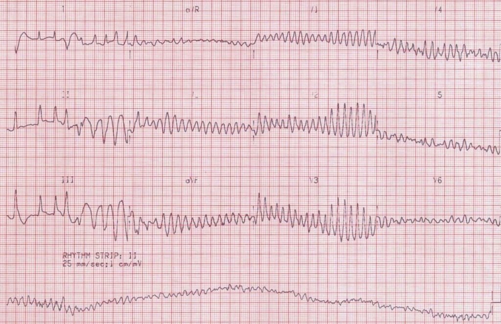 ECG-Ventricular-fibrillation-VF original VF VT