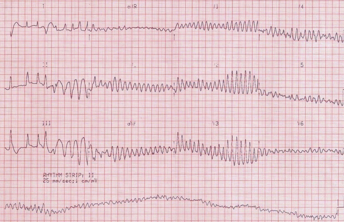 fine ventricular fibrillation vs coarse ventricular fibrillation