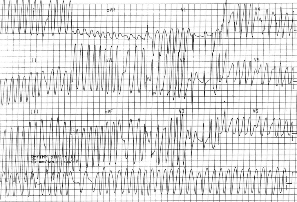 ECG WPW Atrial fibrillation 2