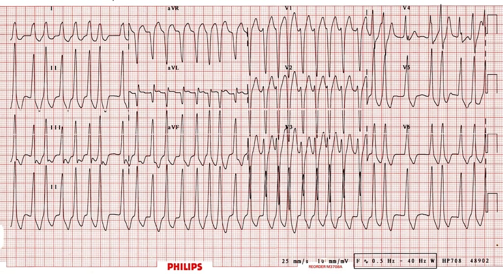 afib with rvr treatment