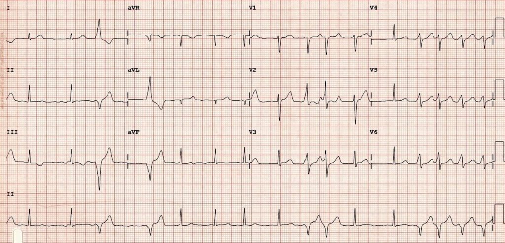 ECG WPW with intermittent pre-excitation