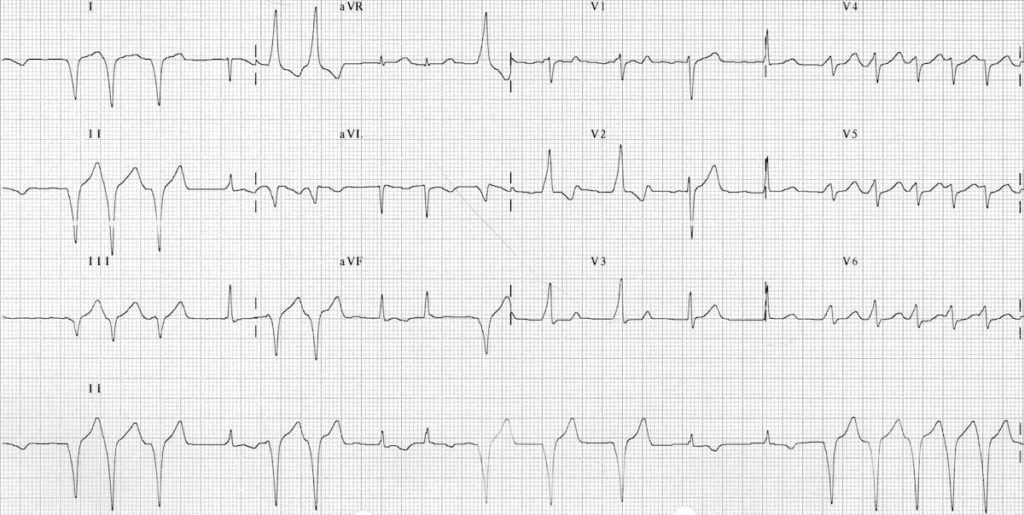 ECG WPW with intermittent pre-excitation 2