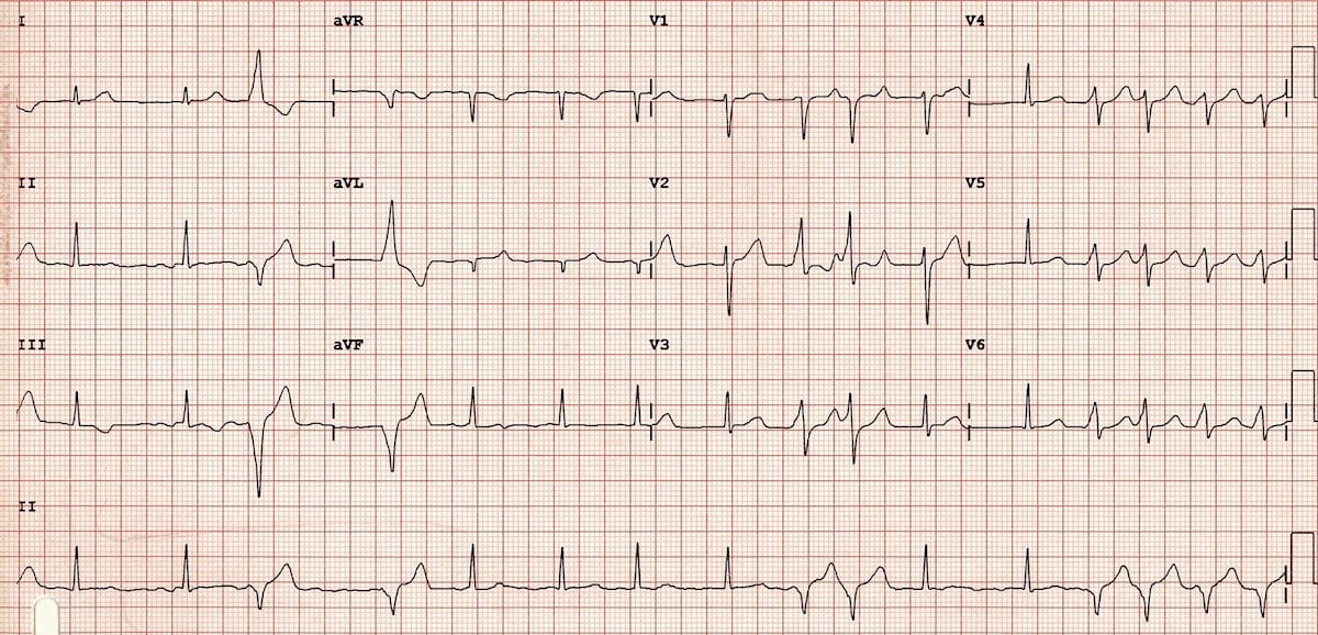 Atrial Fibrillation flutter In Pre excitation LITFL ECG Library