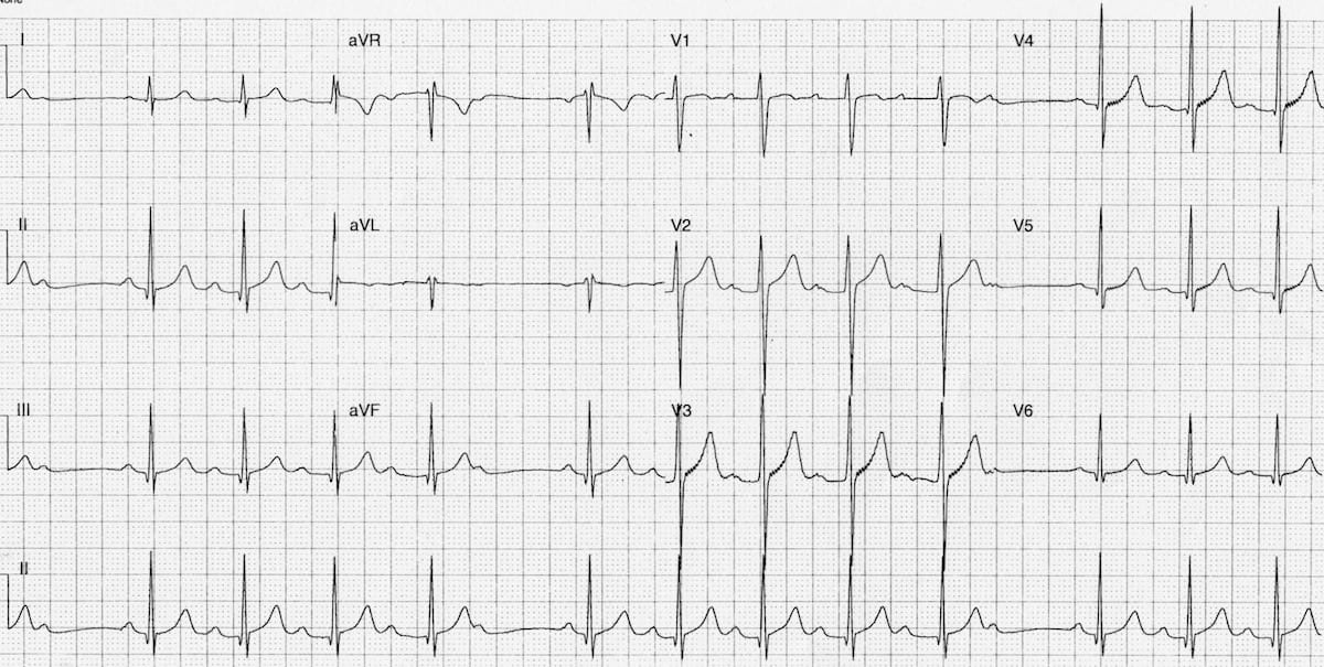 ECG strip showing a Mobitz-1 AV Block