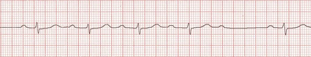 ECG Wenckebach Phenomenon