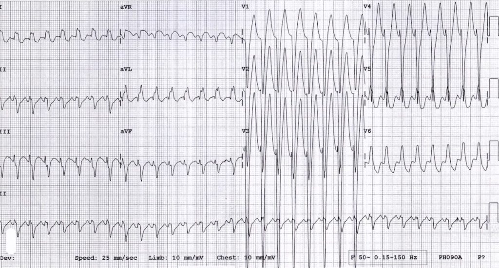 ECG Wolf-Parkinson-White AVRT 15 year old boy