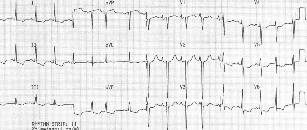 ECG biatrial enlargement 1