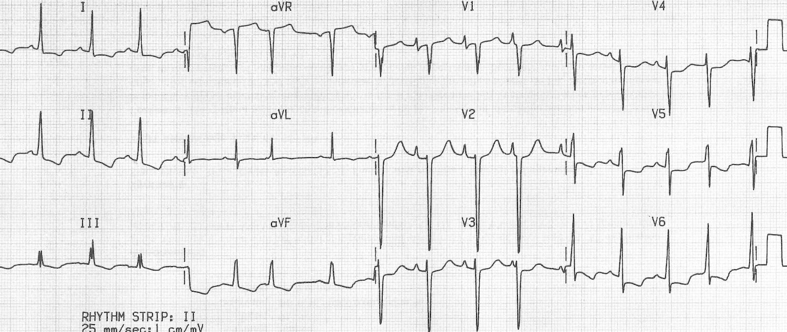 Biatrial Enlargement • LITFL • ECG Library Basics