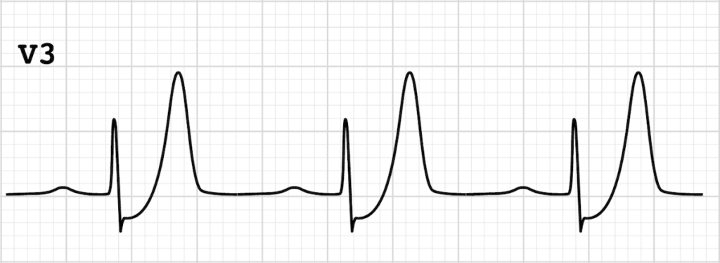 ECG de Winter T-waves V3 strip