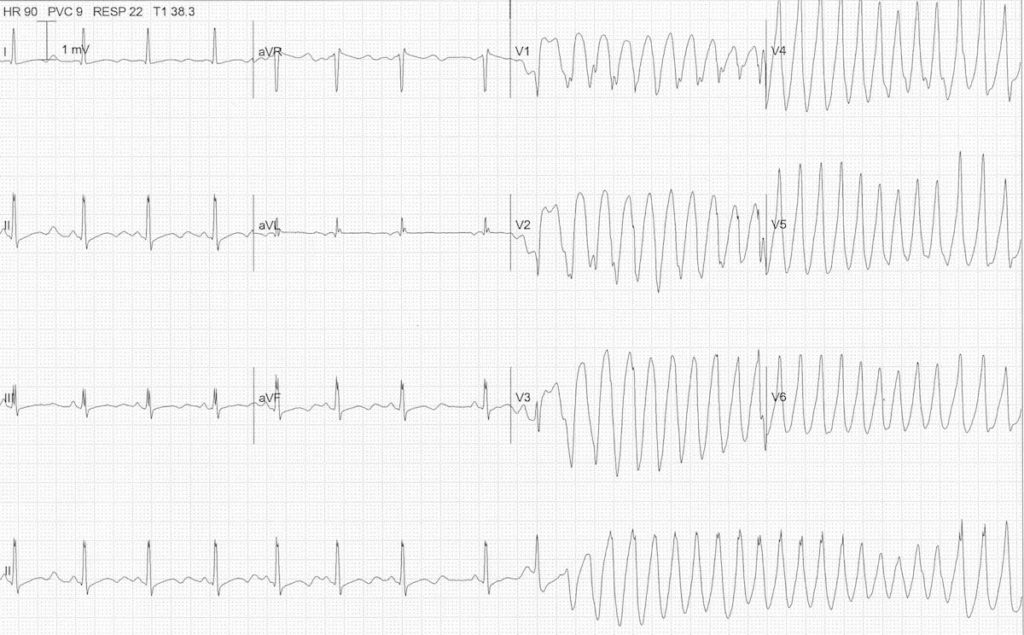 ECG hypokalaemia torsades 2