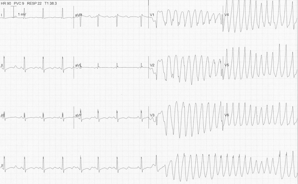 polymorphic ventricular tachycardia vs ventricular fibrillation