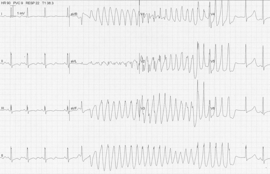 ECG hypokalaemia torsades 3