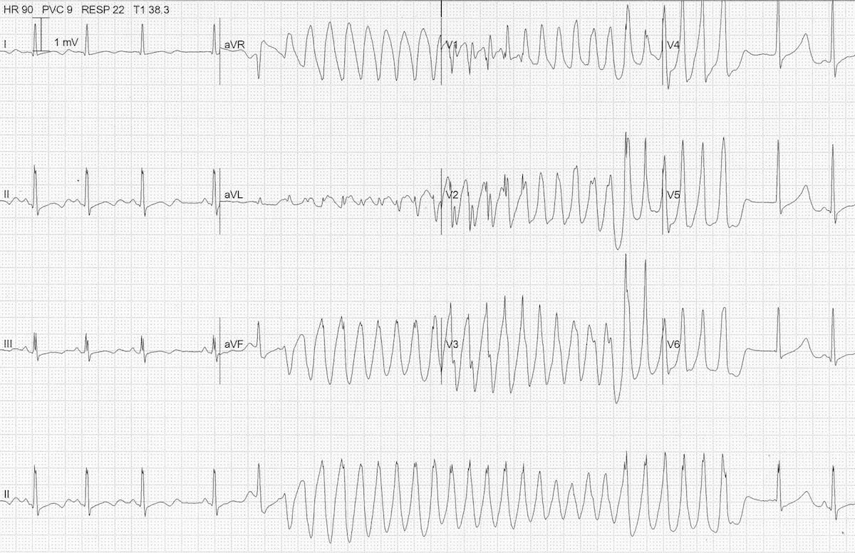 polymorphic ventricular tachycardia ecg