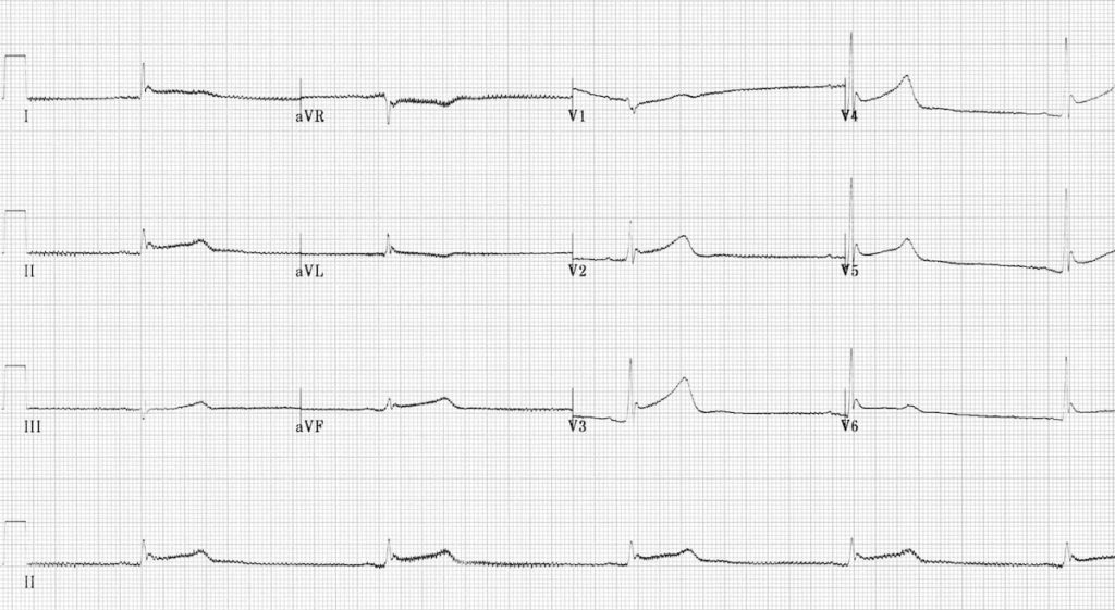 ECG hypothermia shiver artefact bradycardia long QT