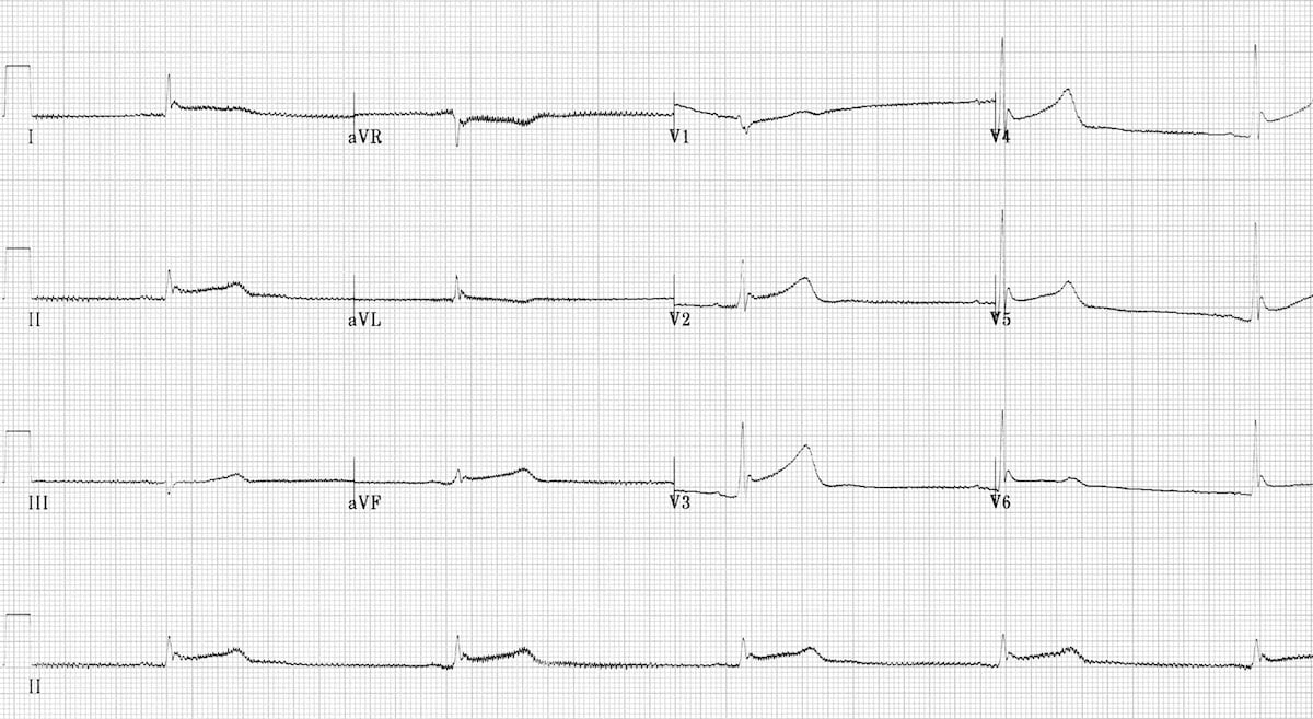 Hypothermia ECG Changes LITFL ECG Library Diagnosis 24684 | The Best ...