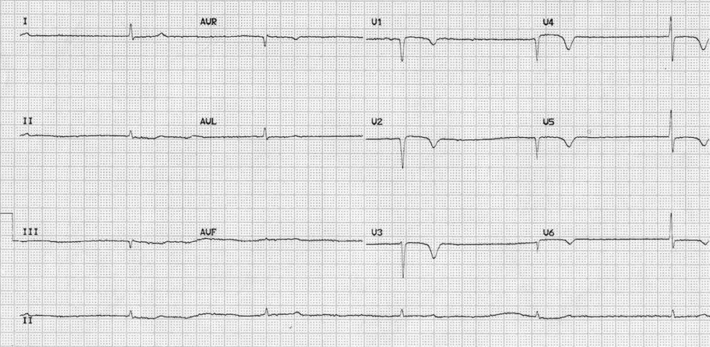 ECG hypothyroid myxoedema coma 1