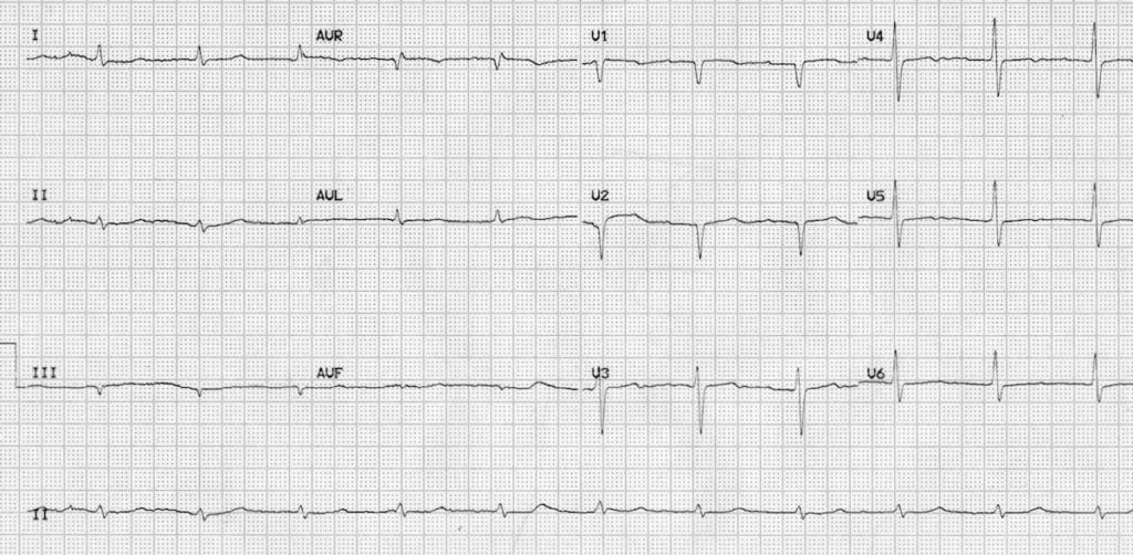 ECG hypothyroid myxoedema coma 2