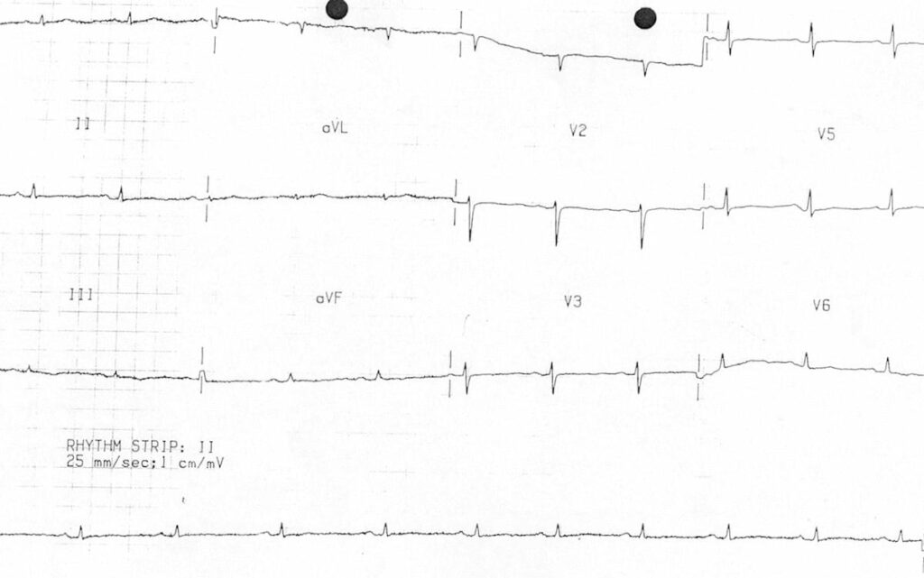 ECG low QRS voltage