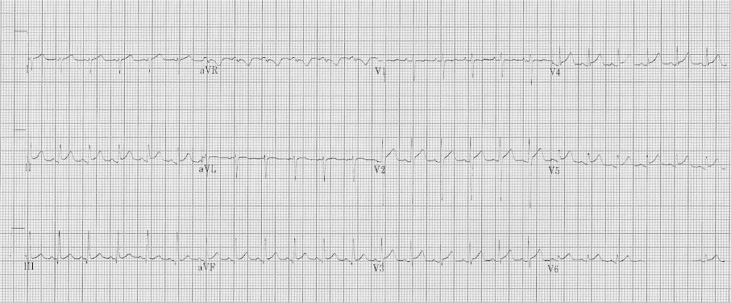 Myocarditis ECG changes • LITFL • ECG Library Diagnosis