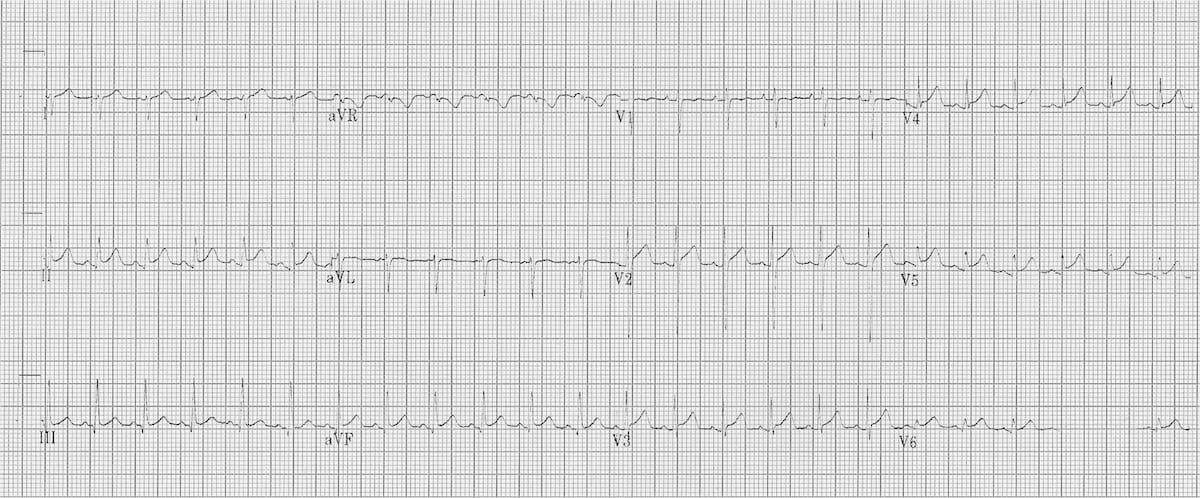 Myocarditis ECG changes • LITFL • ECG Library Diagnosis