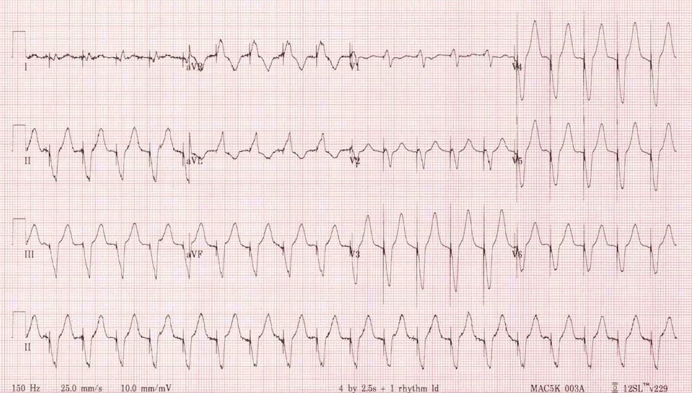 ventricular tachycardia vs supraventricular tachycardia