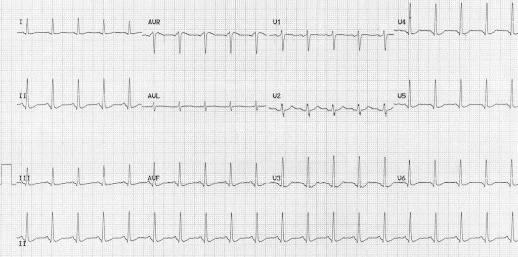 ECG quetiapine overdose 2