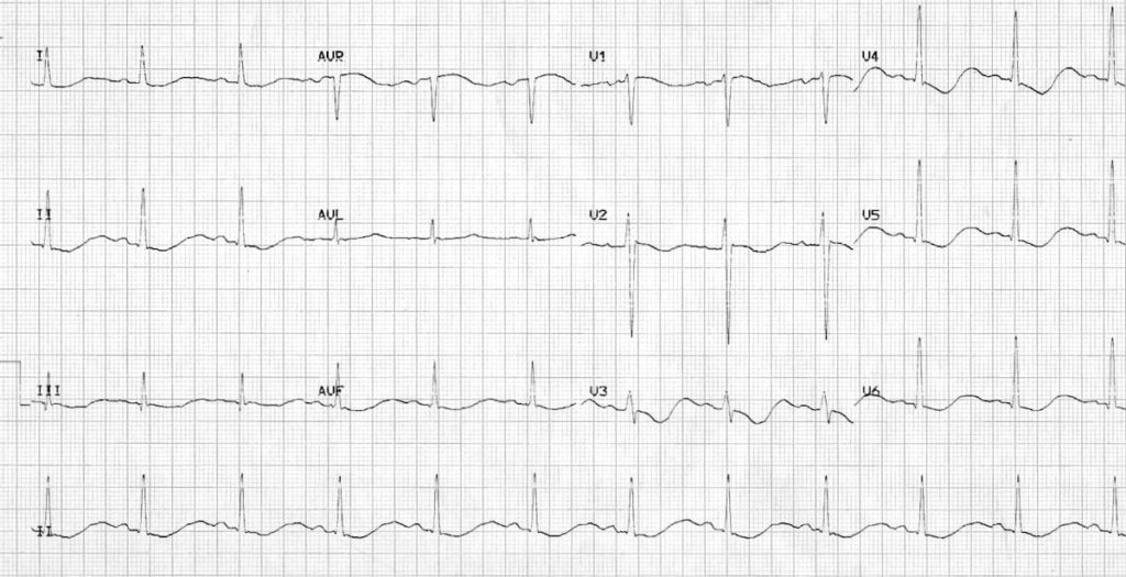 ECG severe hypokalemia serum potassium 1.7