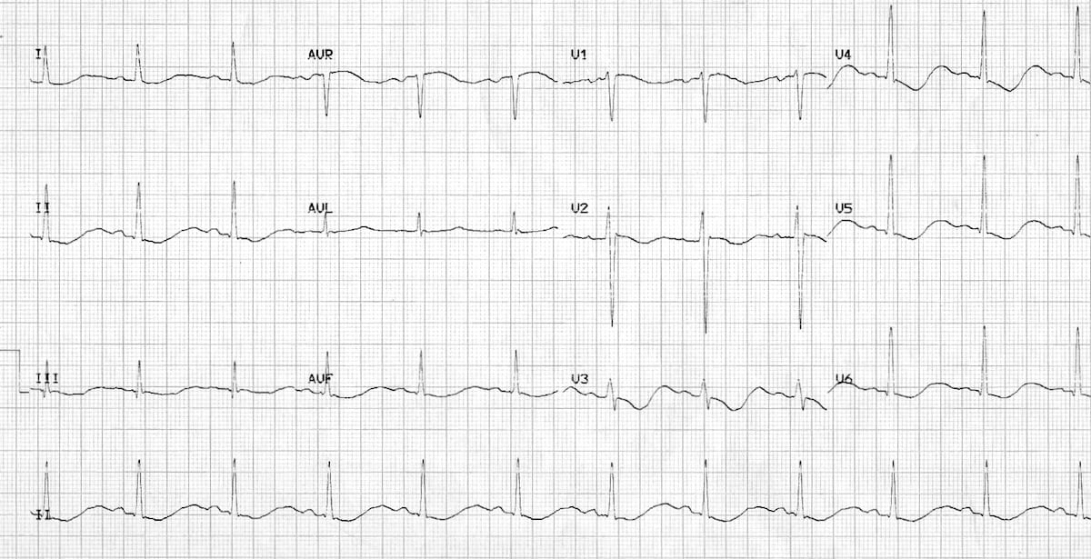 Hypokalaemia ECG changes • LITFL • ECG Library