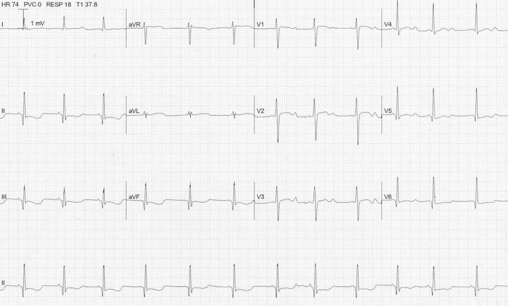 ECG severe hypokalemia serum potassium 1.9