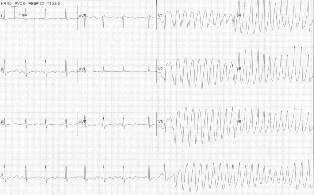 ECG severe hypokalemia serum potassium 2.0 TDP