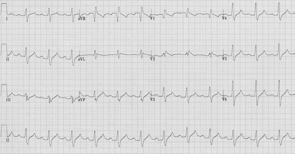 ECG sodium channel blockade Flecainide