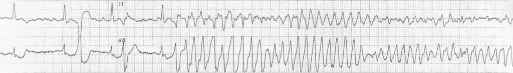 ECG strip Torsades de pointes TDP 2 2