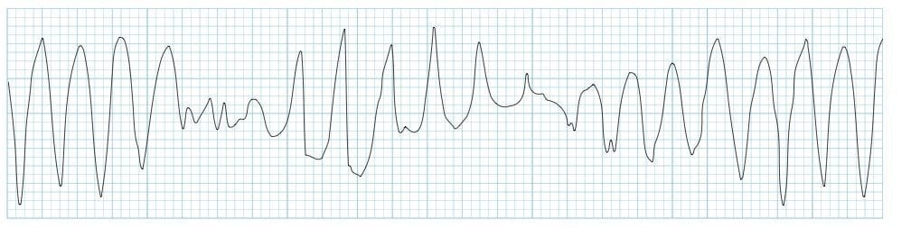 polymorphic ventricular tachycardia vs ventricular fibrillation