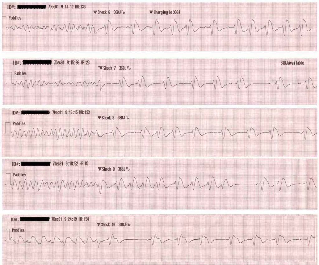 ECG ventricular fibrillation VF rhythm strips