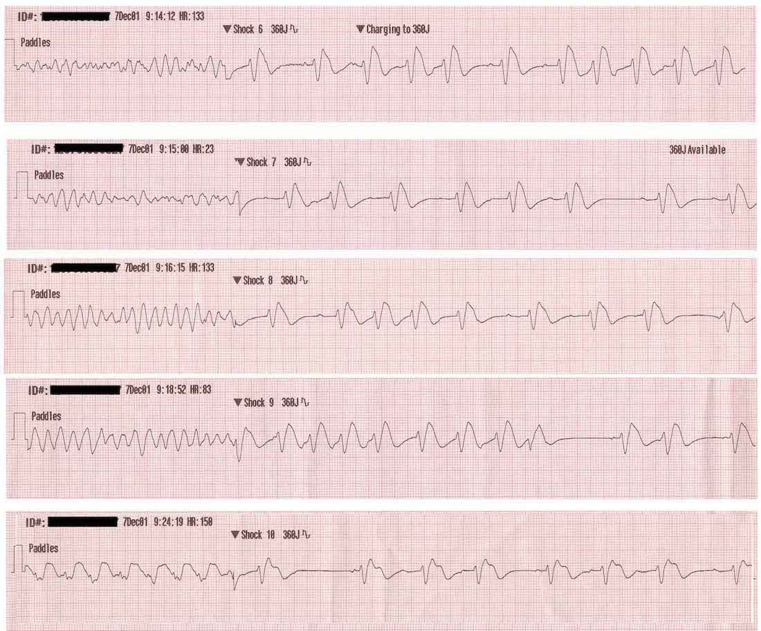 ventricular fibrillation vs atrial fibrillation