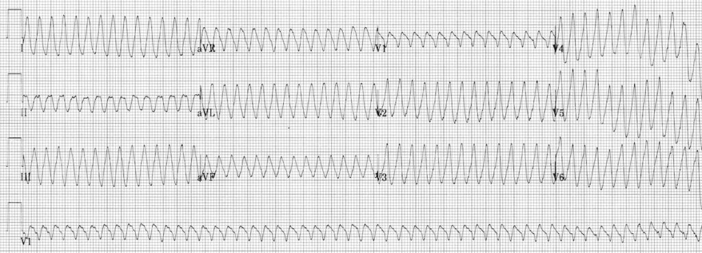 ECG ventricular flutter 4 4