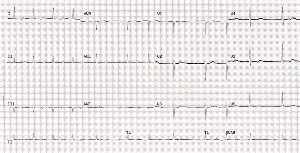 ECG wenckebach atrial pacing