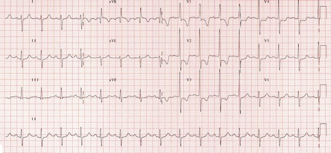 Hipertrofi dan SKA; EKG Dokter Alfa Belajar