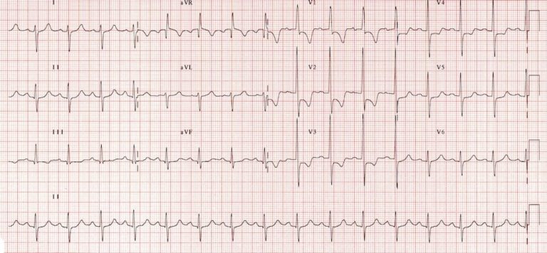 ECG in Right Ventricular Hypertrophy