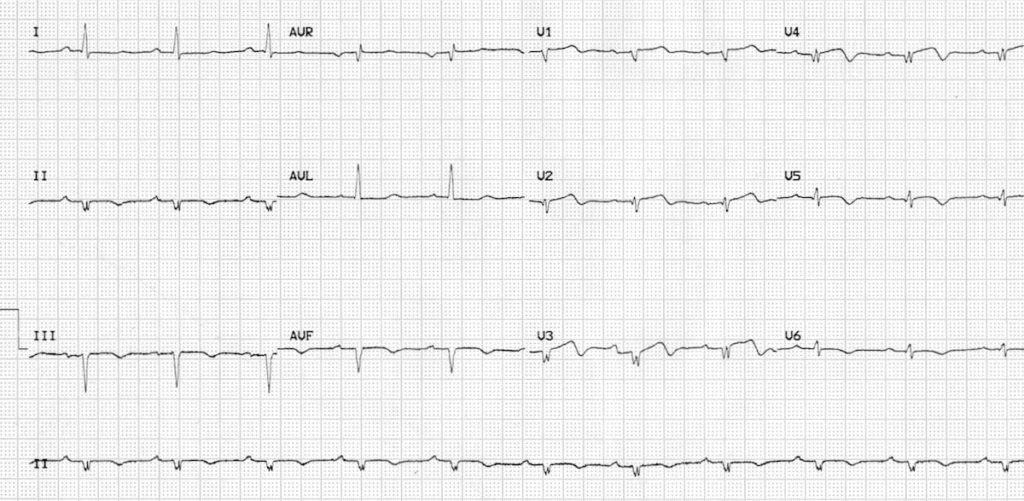 Low voltage in V1-6 due to prior massive anterior MI