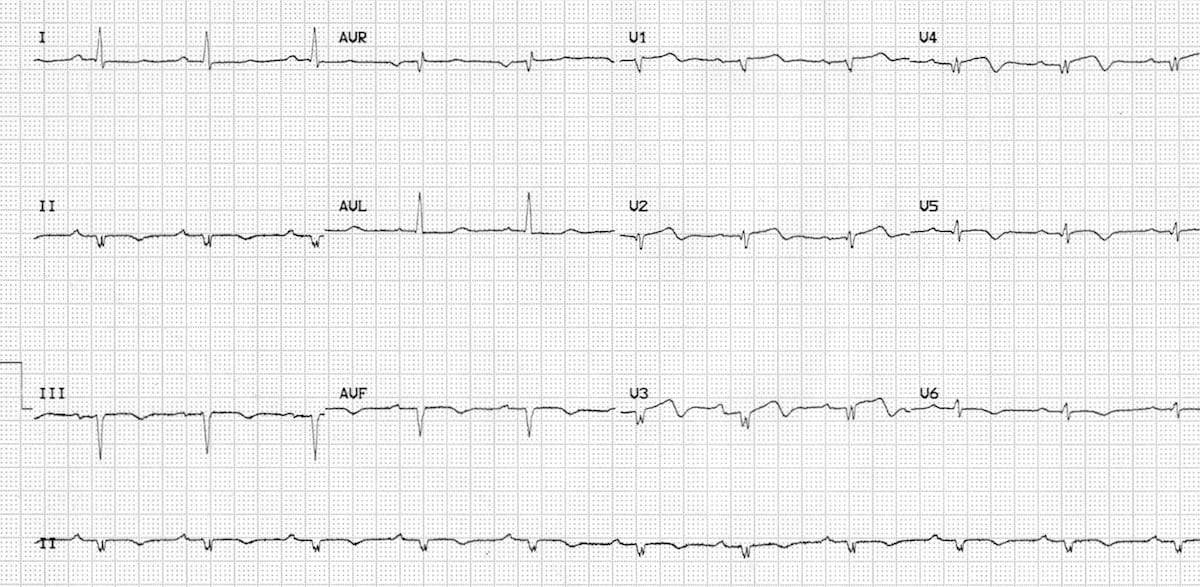 Is Borderline ECG Dangerous? Understanding Your ECG Reports