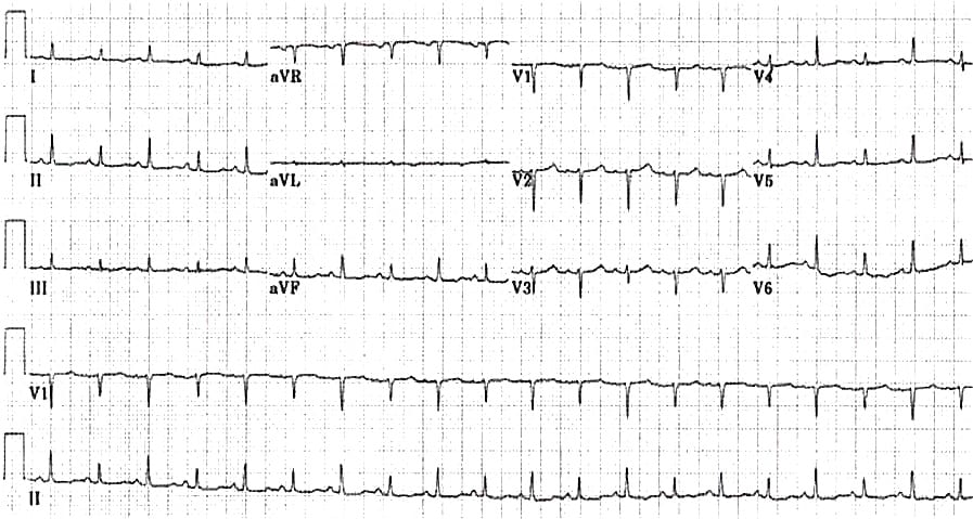 ECG_massive_pericardial_effusion