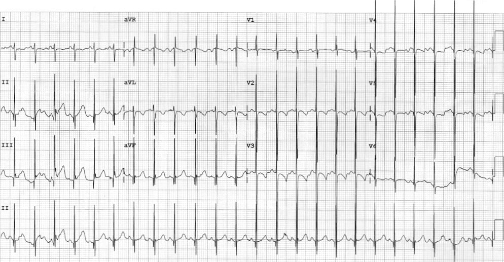 bilateral hypertrophy