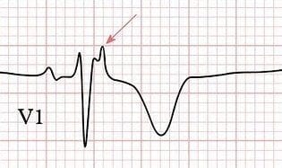 epsilon wave ecg waves syncope arvd litfl abcs right ventricular arrhythmogenic patients